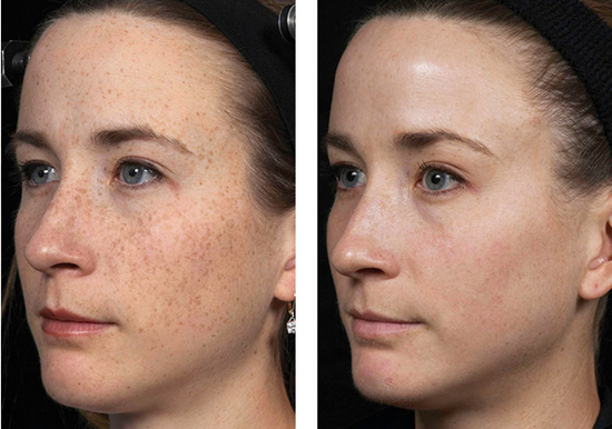 лазерный пилинг лица фото до и после