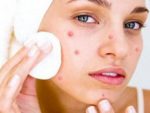 как успокоить воспаленную кожу лица